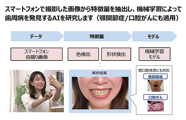 図:歯周病発見AIの概要